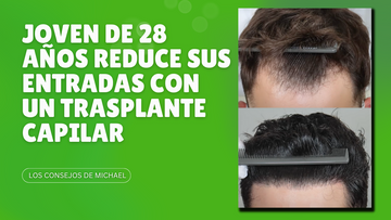 Hombre de 28 años reduce sus entradas con un trasplante capilar