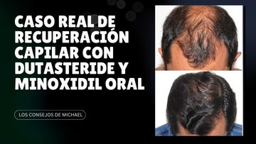 Caso Real de Recuperación Capilar con Dutasteride y Minoxidil Oral
