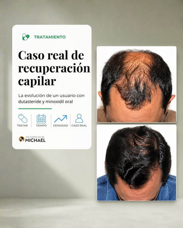 Caso real de recuperación capilar con dutasteride y minoxidil oral - Los Consejos de Michael