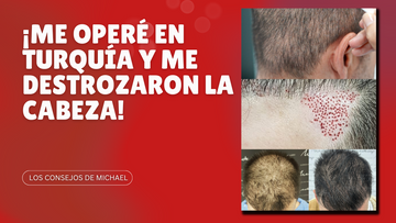 ¡Me OPERÉ en TURQUÍA Y ME DESTROZARON la CABEZA! Me pusieron PELO EN EL MÚSCULO FACIAL