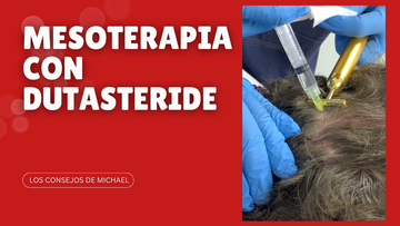 Mesoterapia con dutasteride