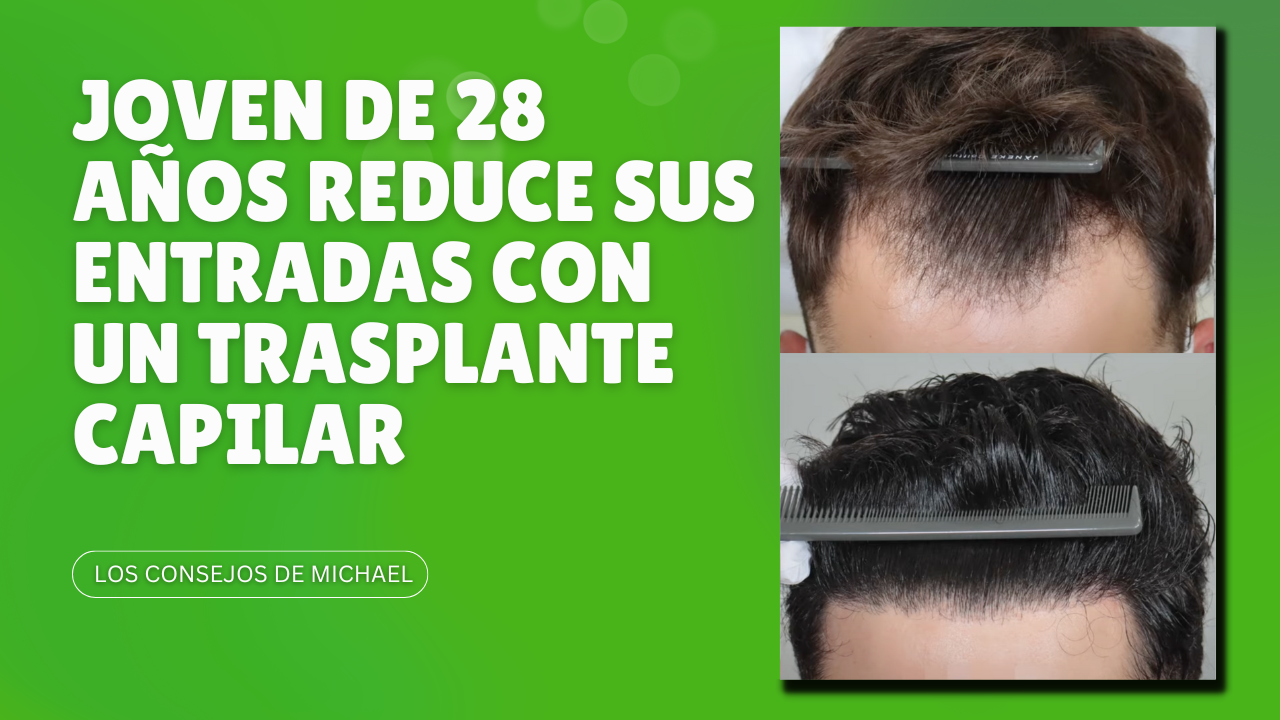 Hombre de 28 años reduce sus entradas con un trasplante capilar