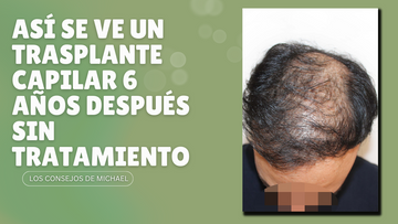 Así se ve un trasplante capilar 6 años después sin medicación