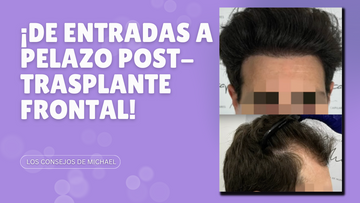 ¡De entradas a pelazo post trasplante capilar frontal!
