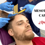 ¿Qué es la mesoterapia capilar? - Los Consejos de Michael