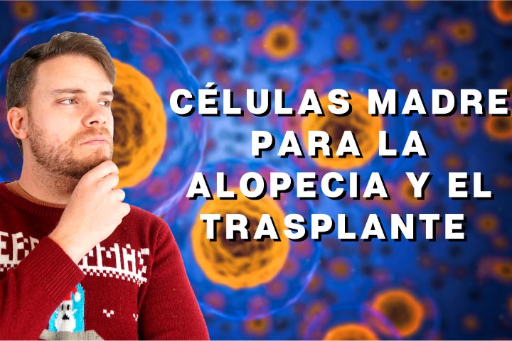 Células madre para la alopecia y el trasplante capilar - Los Consejos de Michael